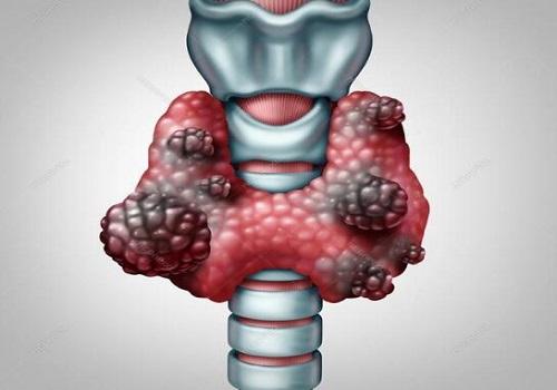 甲状腺癌高发，是摄碘过多还是过度诊断？