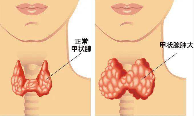 甲状腺肿.jpeg